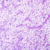 3E1 Angiocentric Glioma (Case 3) PAS 2