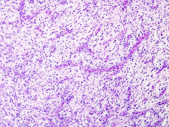 3E1 Angiocentric Glioma (Case 3) PAS 2