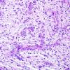 3E2 Angiocentric Glioma (Case 3) PAS 1