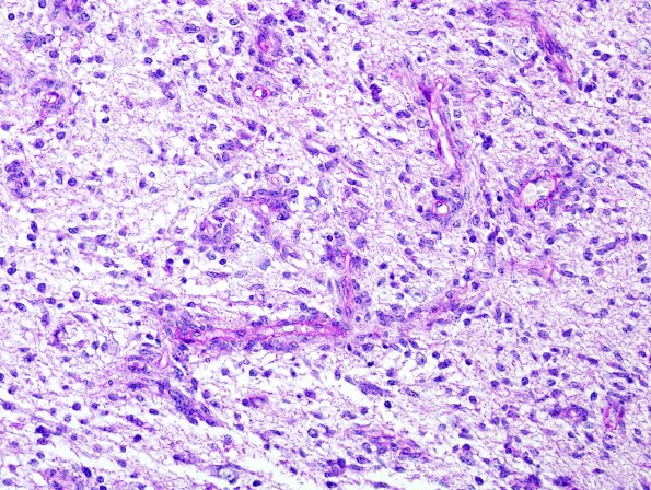 3E2 Angiocentric Glioma (Case 3) PAS 1