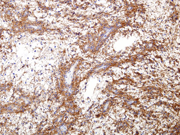 3F1 Angiocentric Glioma (Case 3) CD99 2