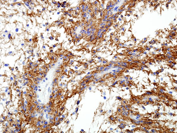 3F2 Angiocentric Glioma (Case 3) CD99 1