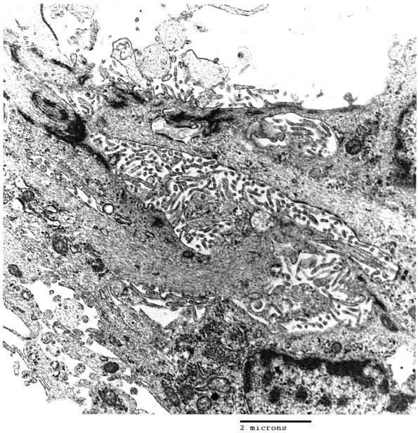 3G1 Angiocentric Glioma (Case 3) EM1 - Copy