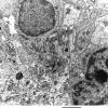 3G2 Angiocentric Glioma (Case 3) EM3 - Copy