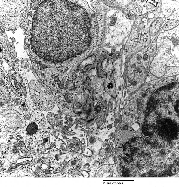 3G2 Angiocentric Glioma (Case 3) EM3 - Copy