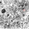 3G3 Angiocentric Glioma (Case 3) EM2 copy - Copy