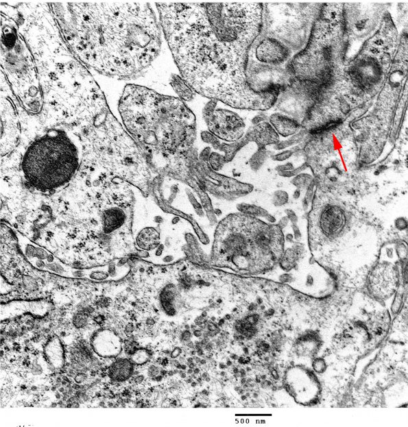 3G3 Angiocentric Glioma (Case 3) EM2 copy - Copy