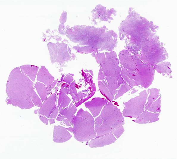 4A1 Angiocentric Glioma (Case 4) 1 H&E WM