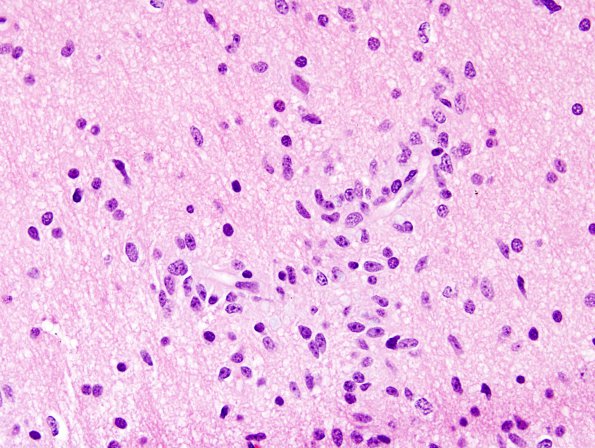 4A10 Angiocentric glioma (Case 4) new H&E 6.j