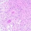 4A2 Angiocentric Glioma (Case 4) 1