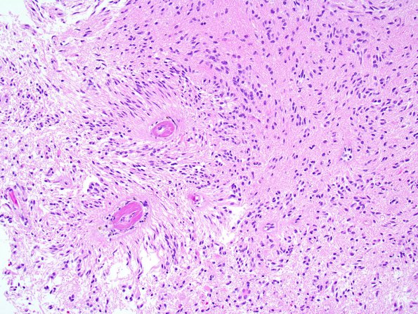 4A2 Angiocentric Glioma (Case 4) 1