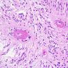 Filename: 4A3 Angiocentric Glioma (Case 4) 2.