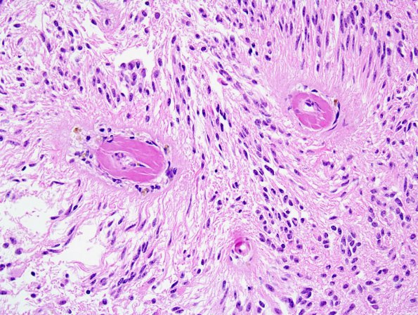 Filename: 4A3 Angiocentric Glioma (Case 4) 2.