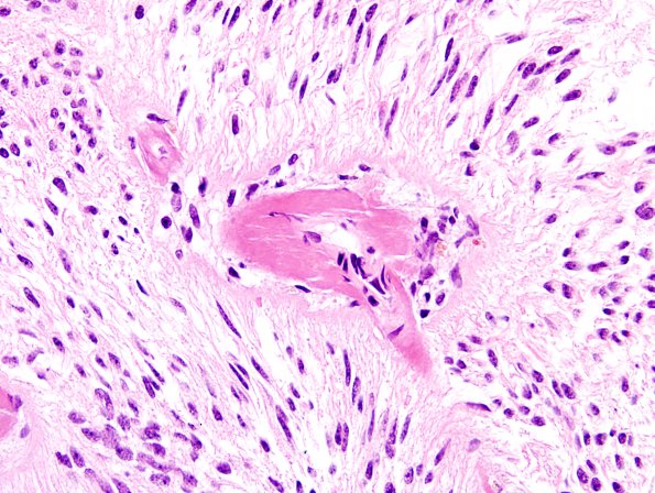 4A4 Angiocentric glioma (Case 4) new H&E 12