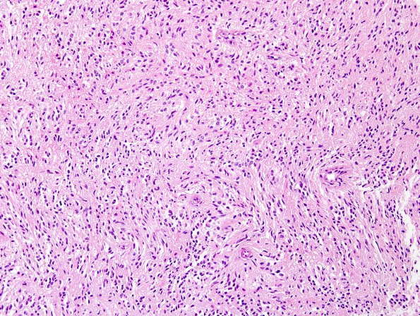 4A5 Angiocentric glioma (Case 4) new H&E 13.