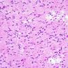 4A6 Angiocentric Glioma (Case 4) 3