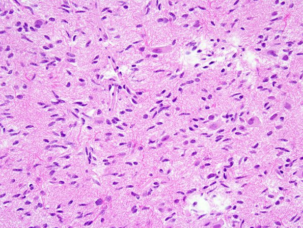 4A6 Angiocentric Glioma (Case 4) 3