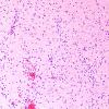 4A7 Angiocentric Glioma (Case 4) H&E 2