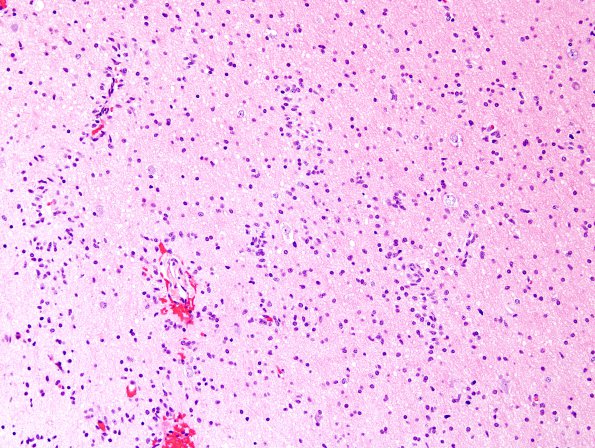 4A7 Angiocentric Glioma (Case 4) H&E 2