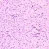 4A8 Angiocentric glioma (Case 4) new H&E 3.j