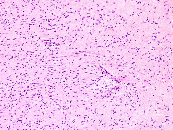 4A8 Angiocentric glioma (Case 4) new H&E 3.j