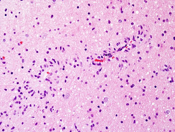 4A9 Angiocentric Glioma (Case 4) H&E 3.j