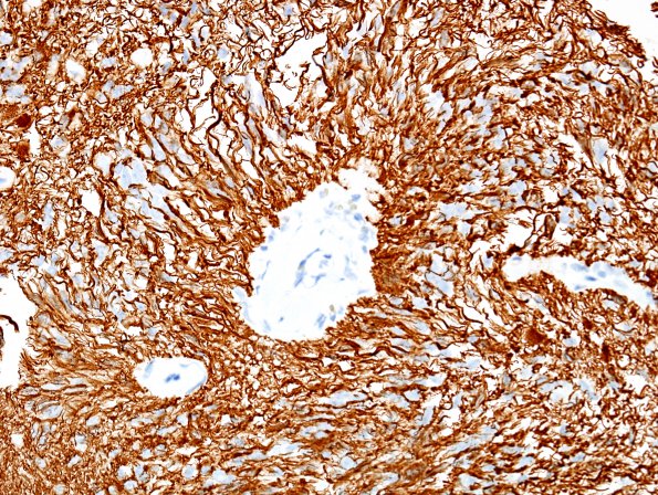 4B5 Angiocentric glioma (Case 4) new GFAP 8