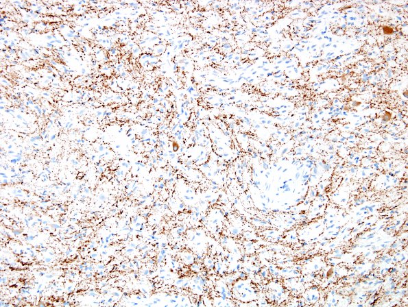 4C2 Angiocentric glioma (Case 4 new NF 4