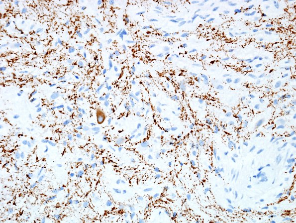 4C3 Angiocentric glioma (Case 4) new NF 6.