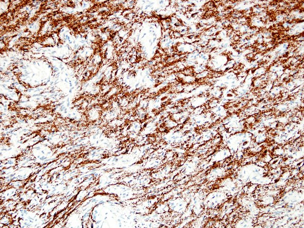 4D Angiocentric Glioma (Case 4) SYN 5