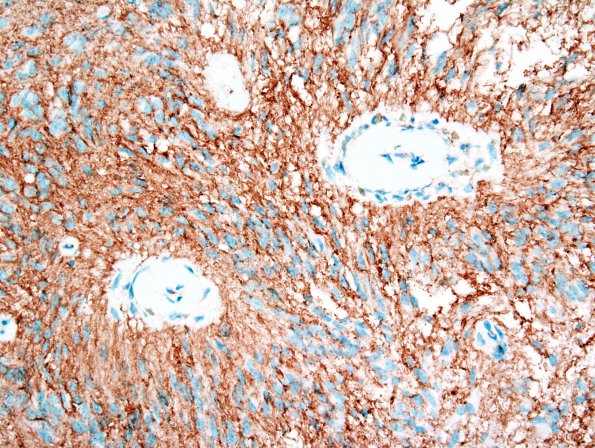 4E2 Angiocentric Glioma (Case 4) CD99 2