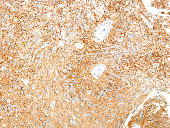 4E4 Angiocentric Glioma (Case 4) CD99 8