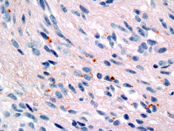 4F1 Angiocentric Glioma (Case 4) EMA 1.