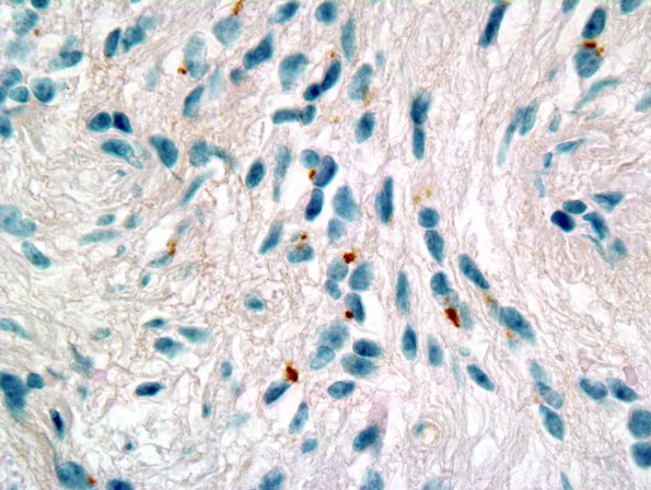 4F2 Angiocentric Glioma (Case 4) EMA 2.