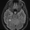 5A1 Angiocentric glioma (Case 5) TIRM - Copy