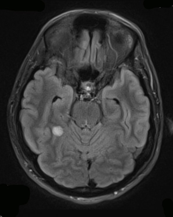 5A1 Angiocentric glioma (Case 5) TIRM - Copy