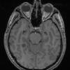 5A2 Angiocentric glioma (Case 5) T1 - Copy