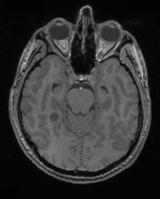 5A2 Angiocentric glioma (Case 5) T1 - Copy