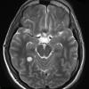 5A3 Angiocentric glioma (Case 5) T2 W 1 - Copy