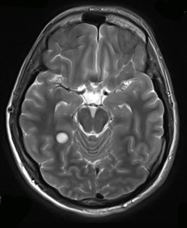 5A3 Angiocentric glioma (Case 5) T2 W 1 - Copy