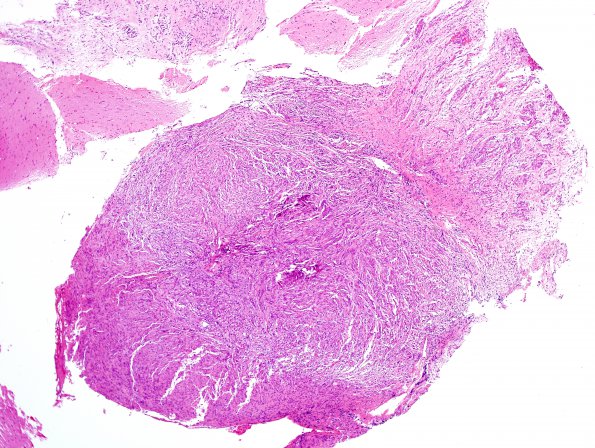 5B1 Angiocentric Glioma (Case 5) H&E 1.