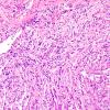 5B2 Angiocentric Glioma (Case 5) H&E 2.