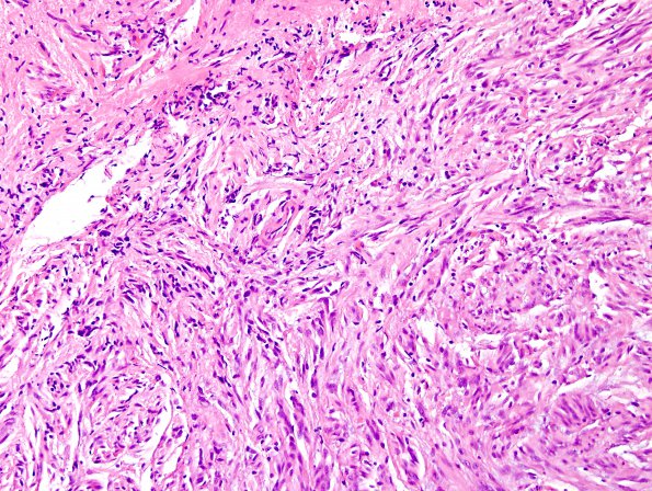 5B2 Angiocentric Glioma (Case 5) H&E 2.