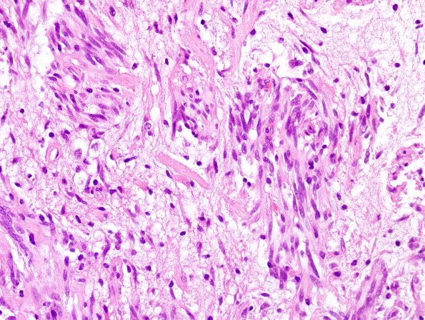 5B3 Angiocentric Glioma (Case 5) H&E 6