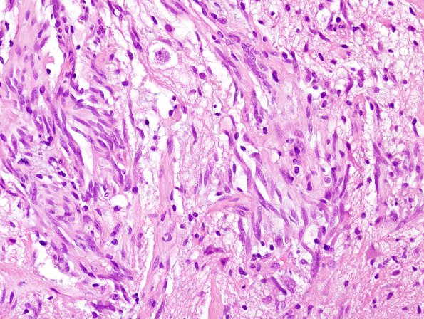 5B4 Angiocentric Glioma (Case 5) H&E 5