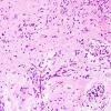 5B5 Angiocentric Glioma (Case 5) H&E 8.