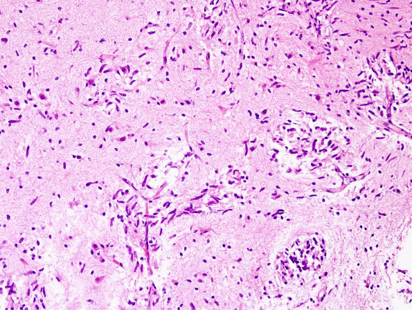 5B5 Angiocentric Glioma (Case 5) H&E 8.