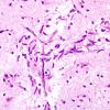 5B6 Angiocentric Glioma (Case 5) H&E 9