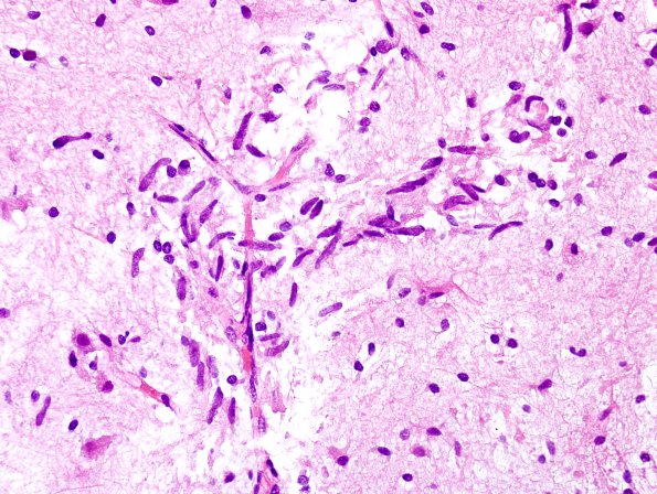 5B6 Angiocentric Glioma (Case 5) H&E 9