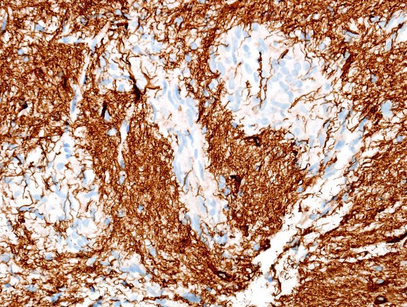 5C3 Angiocentric Glioma (Case 5) GFAP 1